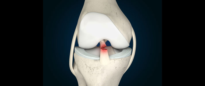 ACL Injuries