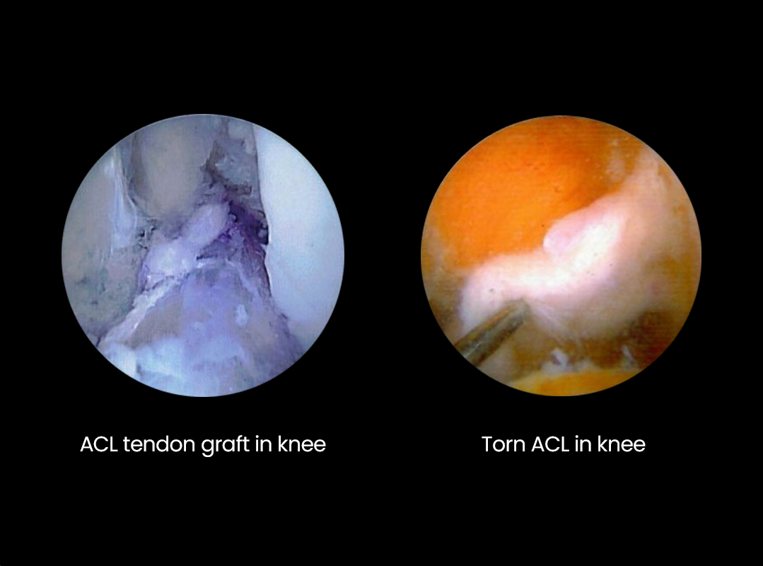 ACL tendon graft and torn ACL