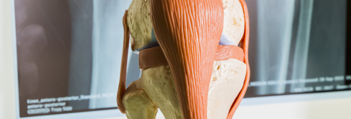 ACL Impingement